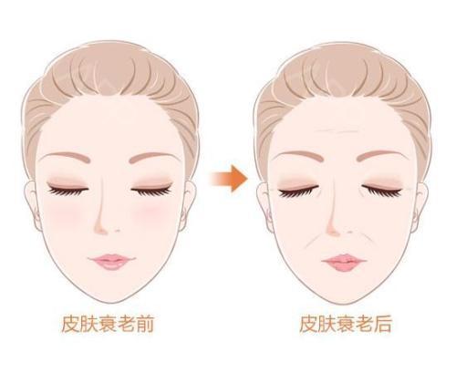 面部提升术