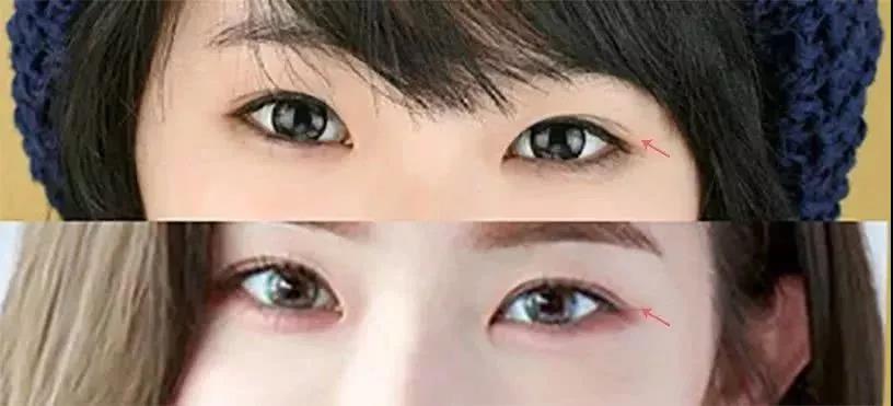 双眼皮手术