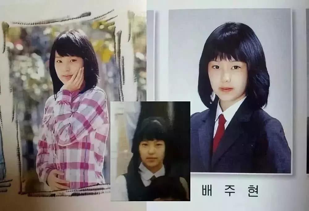 双眼皮手术