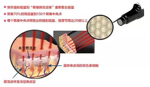 超皮秒祛斑