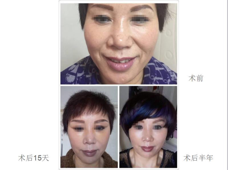 面部提升术