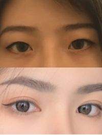 双眼皮手术