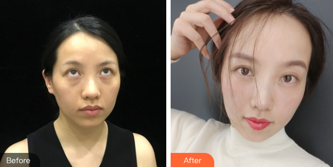 去眼袋手术