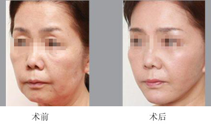 面部提升术