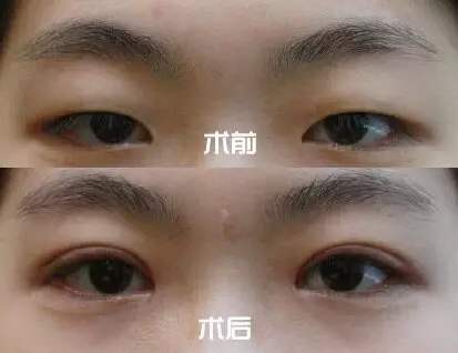 双眼皮手术