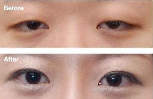 双眼皮手术