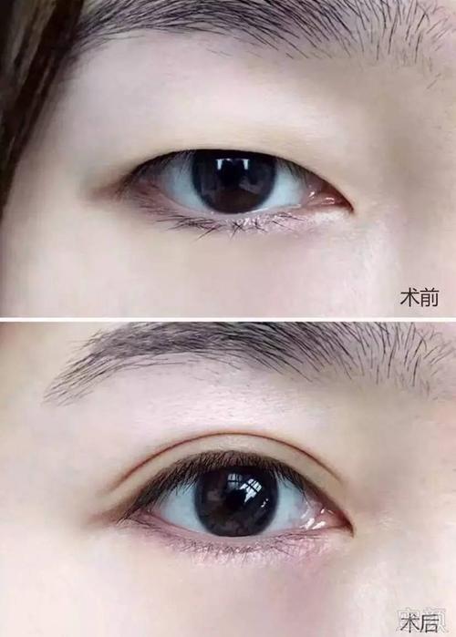 双眼皮手术