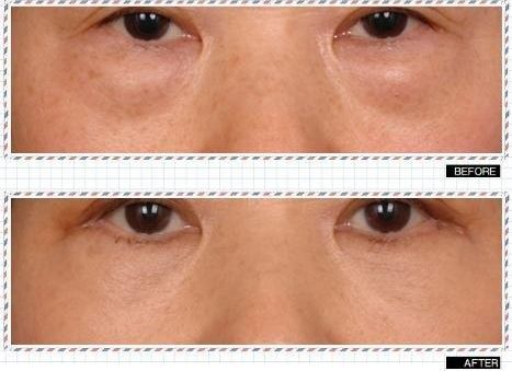 去眼袋手术