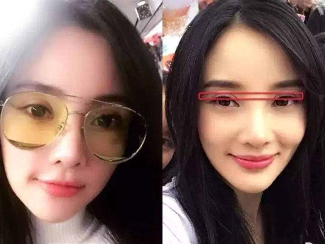 双眼皮手术