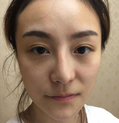 自体脂肪填充术