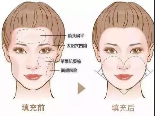 自体脂肪填充术