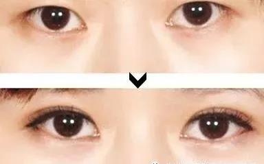 双眼皮手术