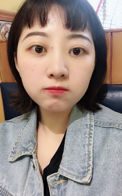双眼皮手术