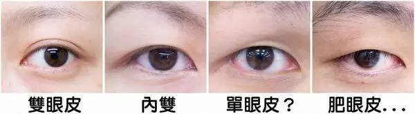 双眼皮手术