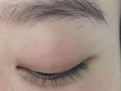 双眼皮手术