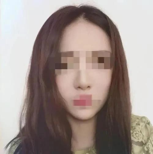 自体脂肪填充术