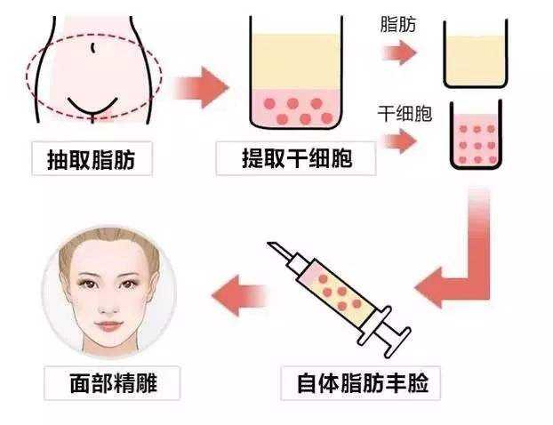 自体脂肪填充术