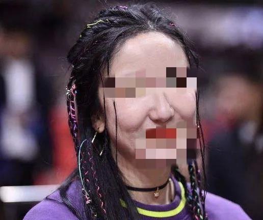 自体脂肪填充术