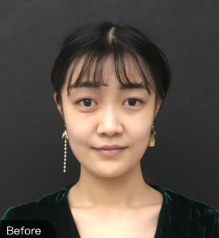 隆鼻手术