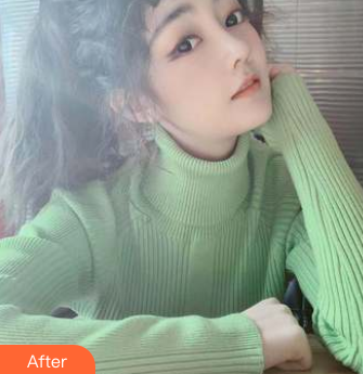 隆鼻手术