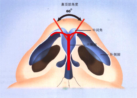 隆鼻手术