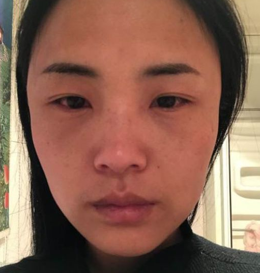 去眼袋手术