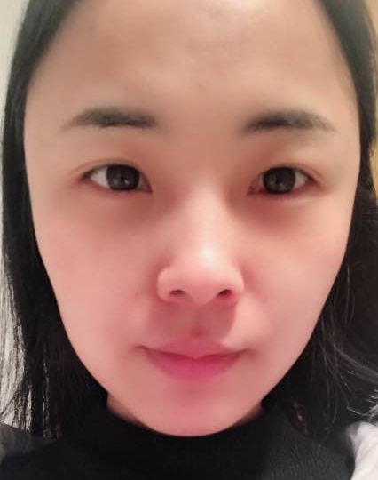 去眼袋手术