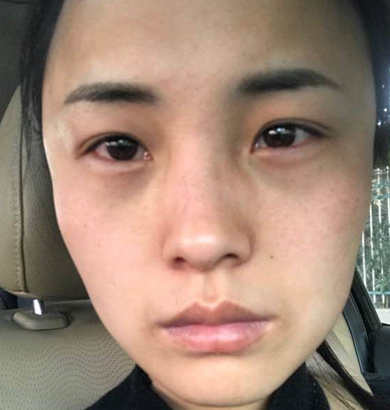 去眼袋手术