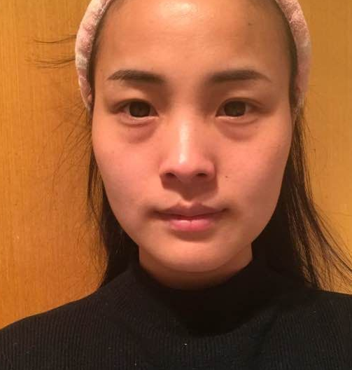 去眼袋手术