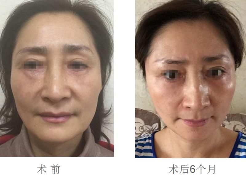 面部提升术