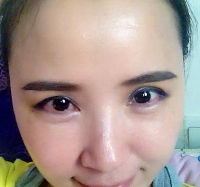 玻尿酸丰卧蚕