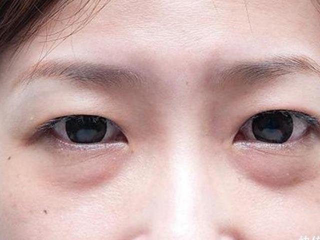 去眼袋手术