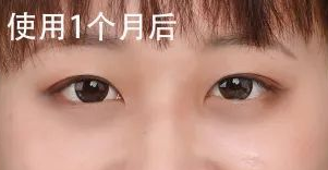 去眼袋手术