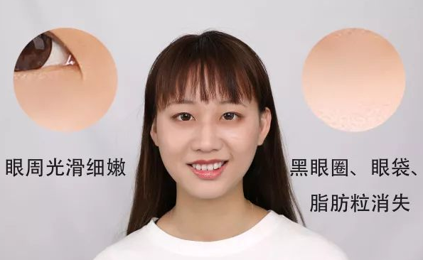 去眼袋手术