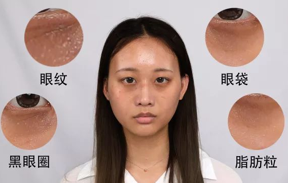 去眼袋手术