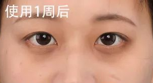去眼袋手术