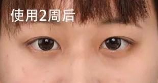去眼袋手术