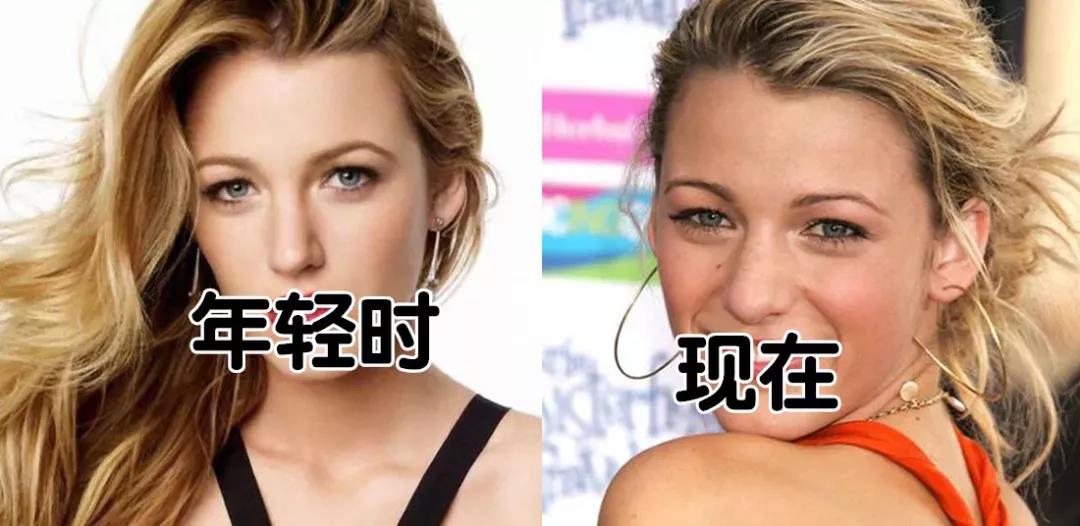 隆鼻手术