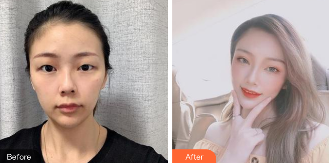 双眼皮手术