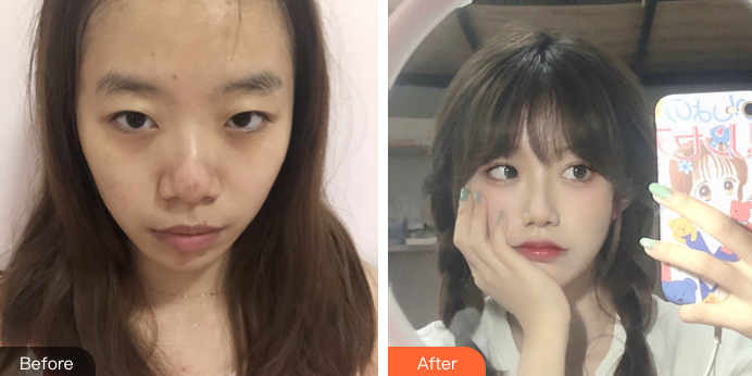双眼皮手术