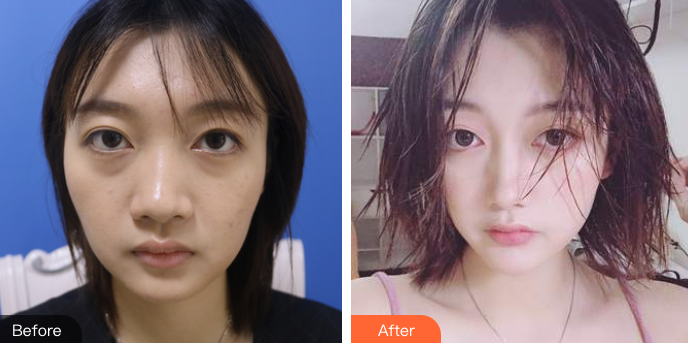 去眼袋手术