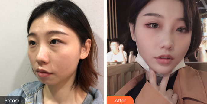 长效玻尿酸