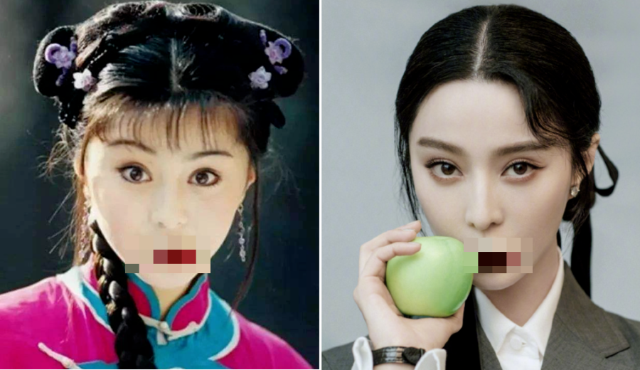 双眼皮手术