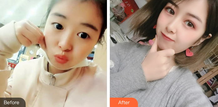 双眼皮手术