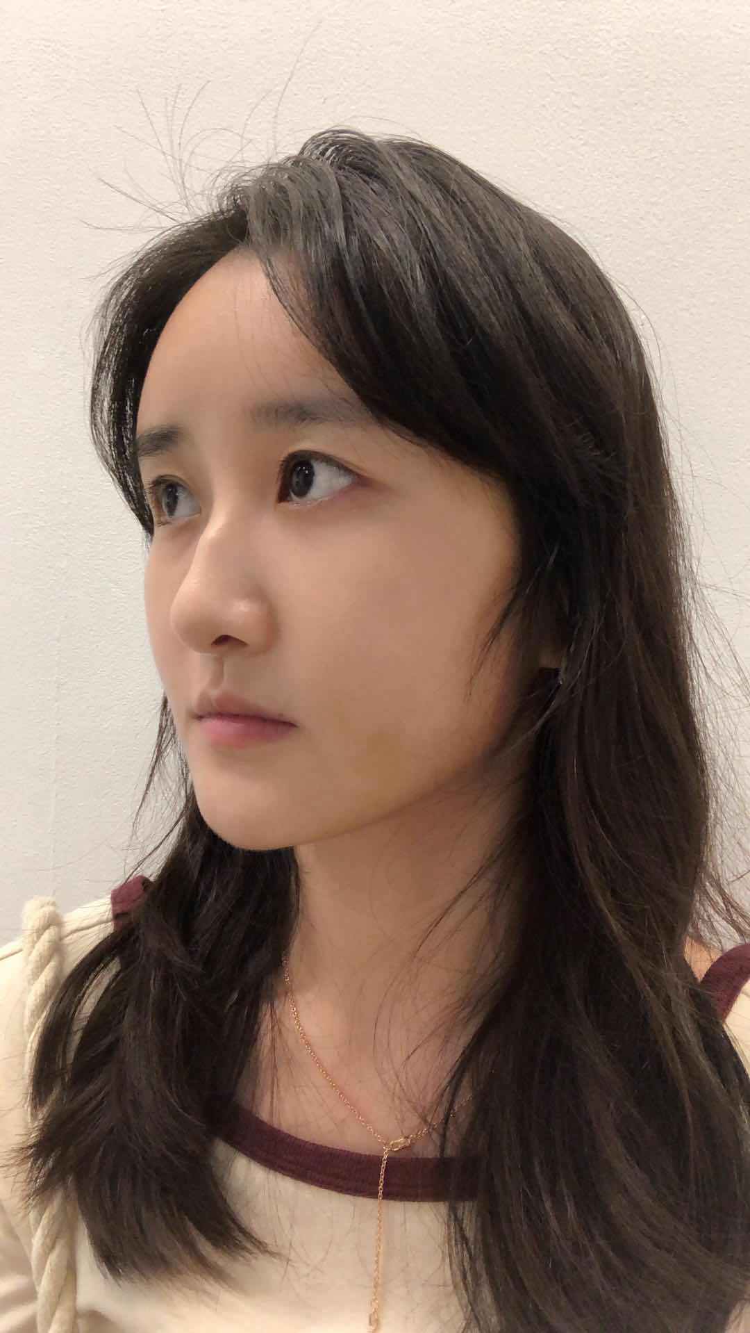 自体脂肪填充术