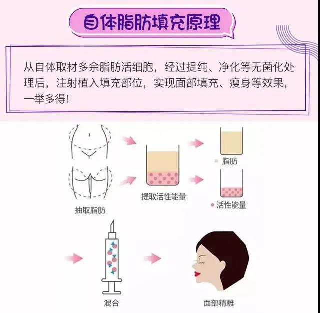 自体脂肪填充术