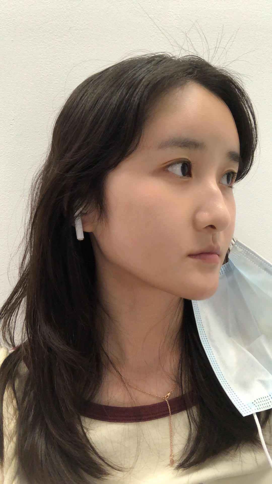 自体脂肪填充术