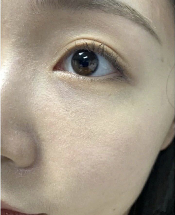 去眼袋手术