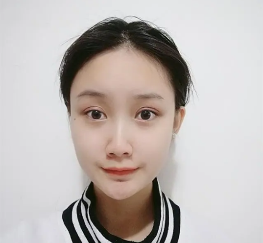 去眼袋手术