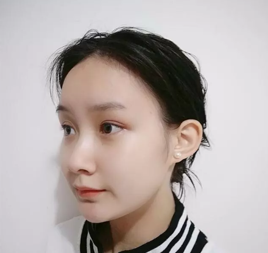 去眼袋手术